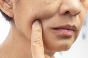 顔のたるみの原因とは？予防方法や皮膚科で受けられる治療を解説